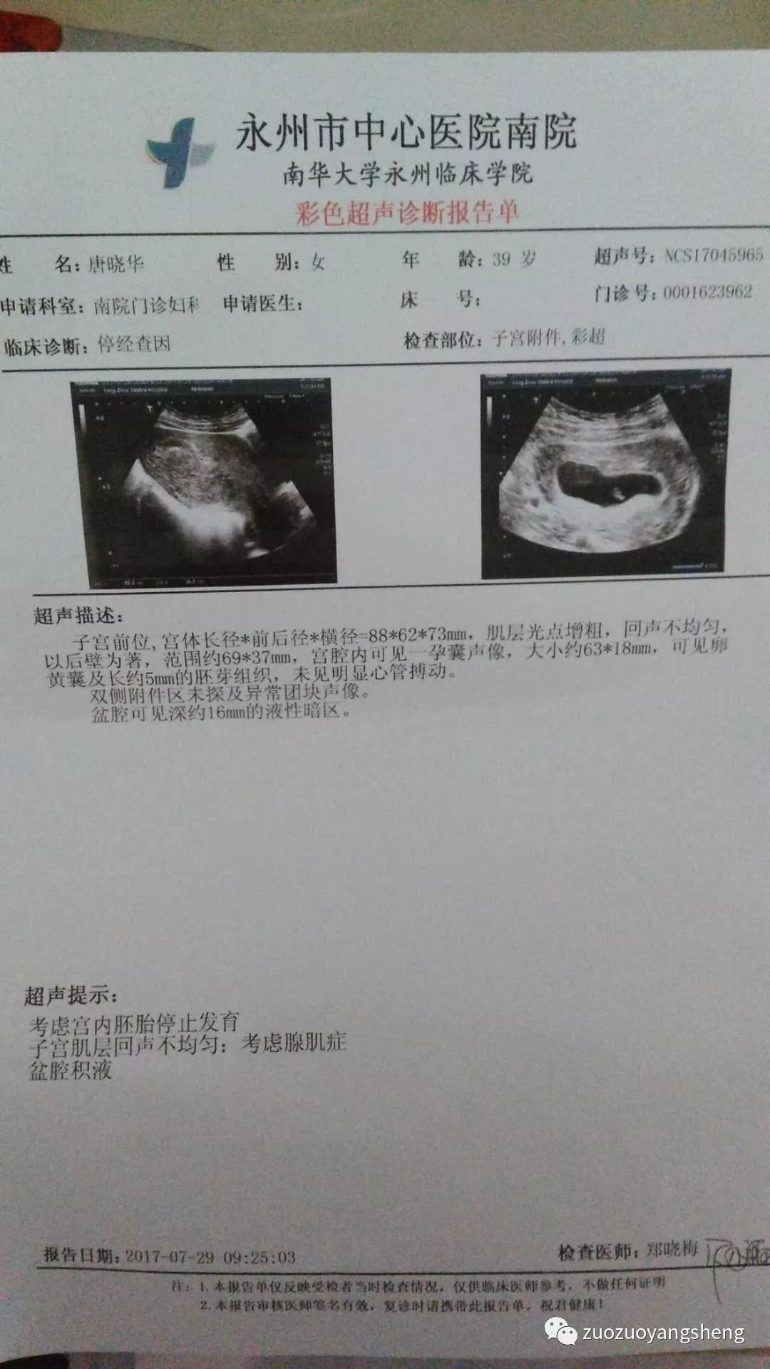 坚持原始点调理,43天排出死胎的案例 坚持原始点调理,43天排出死胎的案例