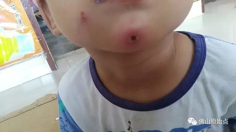 佛山原始点中心学员花开深圳:妈妈用原始点为七岁儿调理水痘9天康复案例 佛山原始点中心学员花开深圳:妈妈用原始点为七岁儿调理水痘9天康复案例