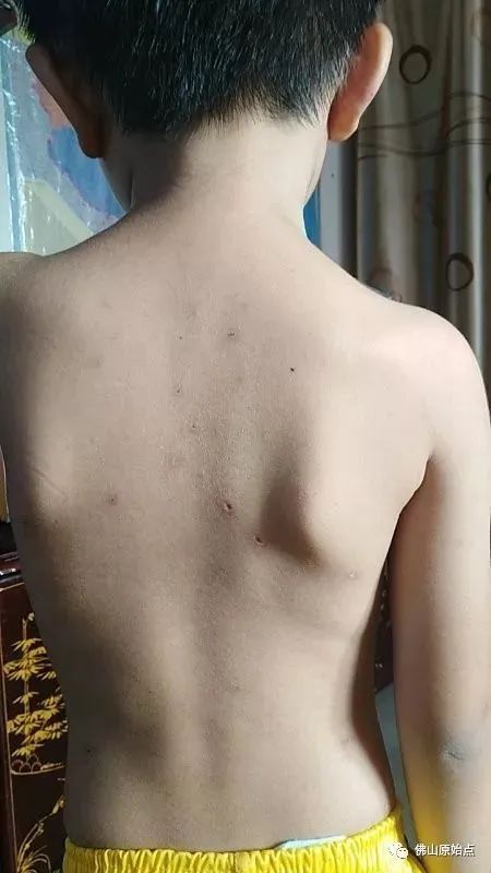 佛山原始点中心学员花开深圳:妈妈用原始点为七岁儿调理水痘9天康复案例 佛山原始点中心学员花开深圳:妈妈用原始点为七岁儿调理水痘9天康复案例