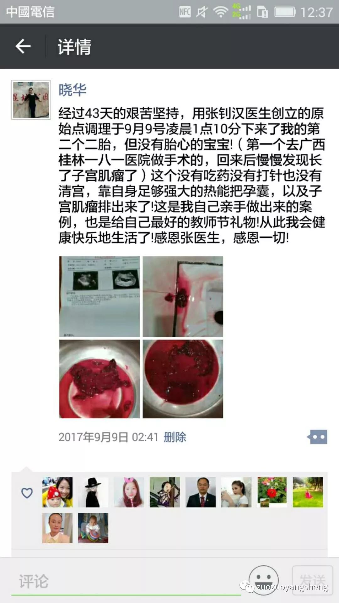 坚持原始点调理,43天排出死胎的案例 坚持原始点调理,43天排出死胎的案例