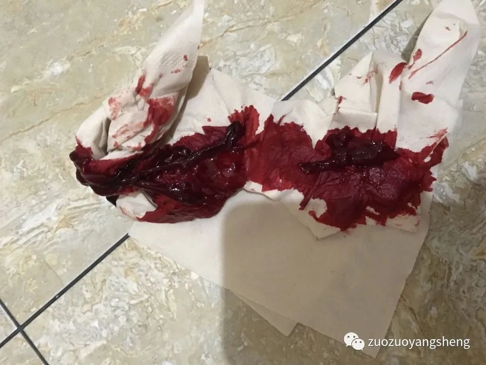 案例分享:原始点调理子宫大出血的案例 案例分享:原始点调理子宫大出血的案例