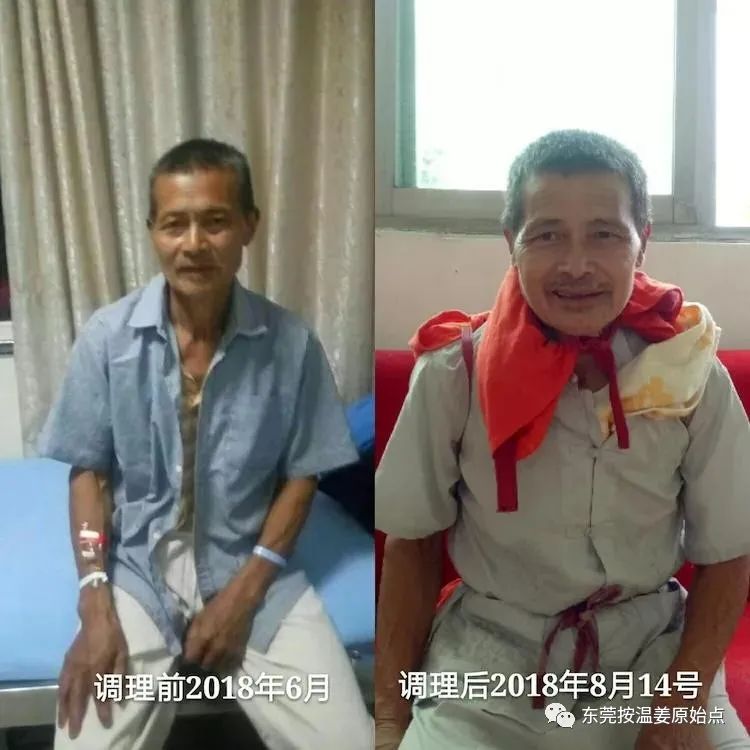 直肠癌没经手术放化疗,肠梗阻,肺结核,肺气肿 直肠癌没经手术放化疗,肠梗阻,肺结核,肺气肿