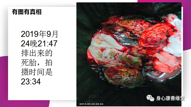 怀胎七月,胎死腹中2月患者康复案例 怀胎七月,胎死腹中2月患者康复案例