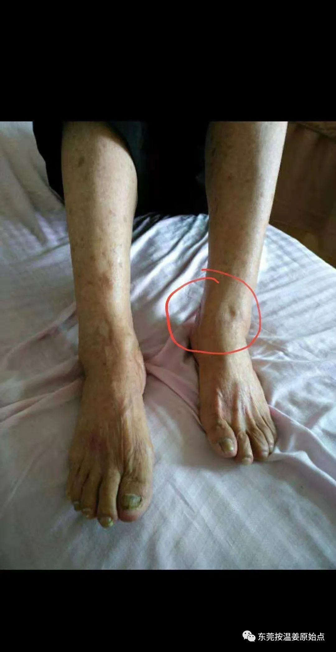 肝硬化肝腹水,双腿小肿,用原始点十天消肿 肝硬化肝腹水,双腿小肿,用原始点十天消肿