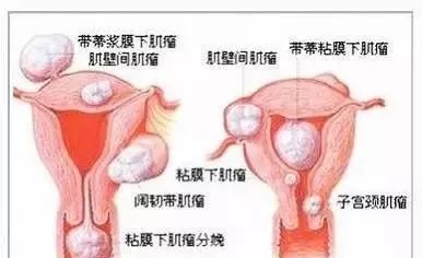 中医解读子宫肌瘤、卵巢囊肿是怎么回事？