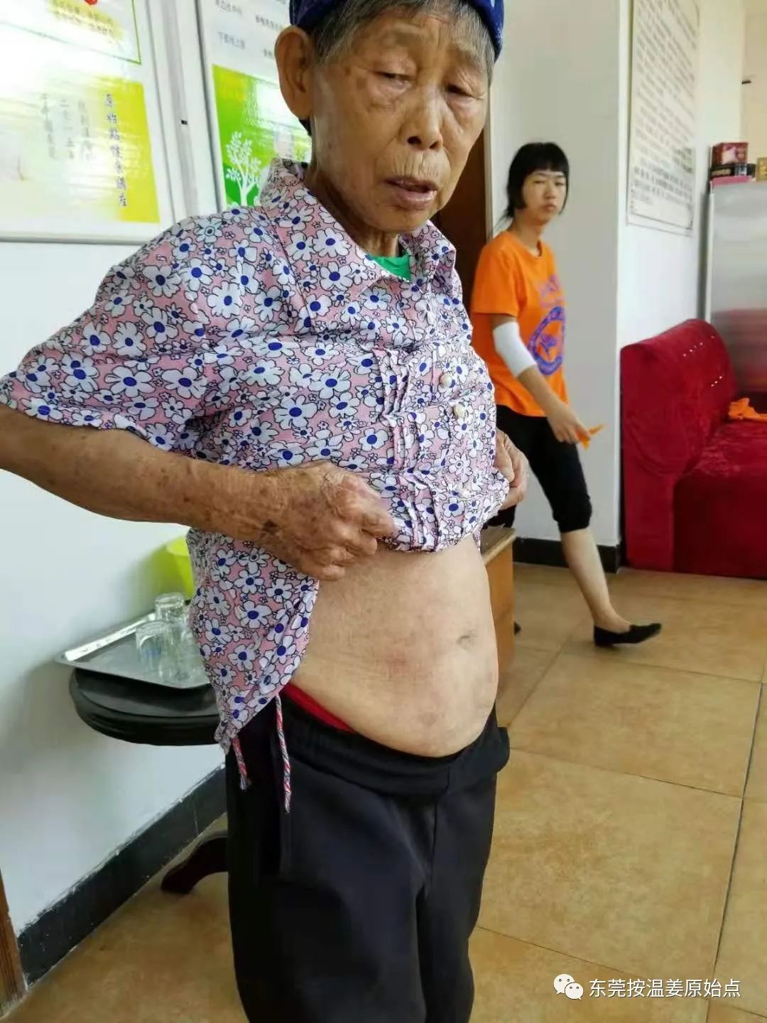 肝硬化肝腹水,双腿小肿,用原始点十天消肿 肝硬化肝腹水,双腿小肿,用原始点十天消肿