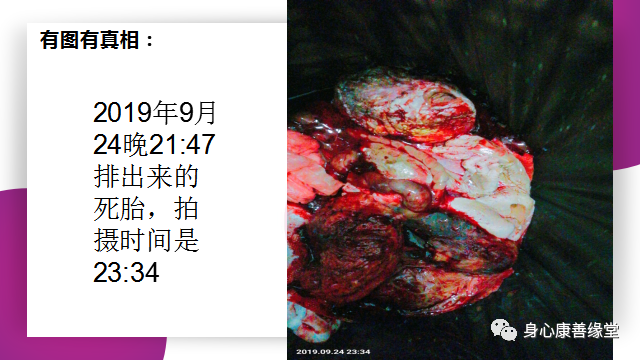 怀胎七月,胎死腹中2月患者康复案例 怀胎七月,胎死腹中2月患者康复案例