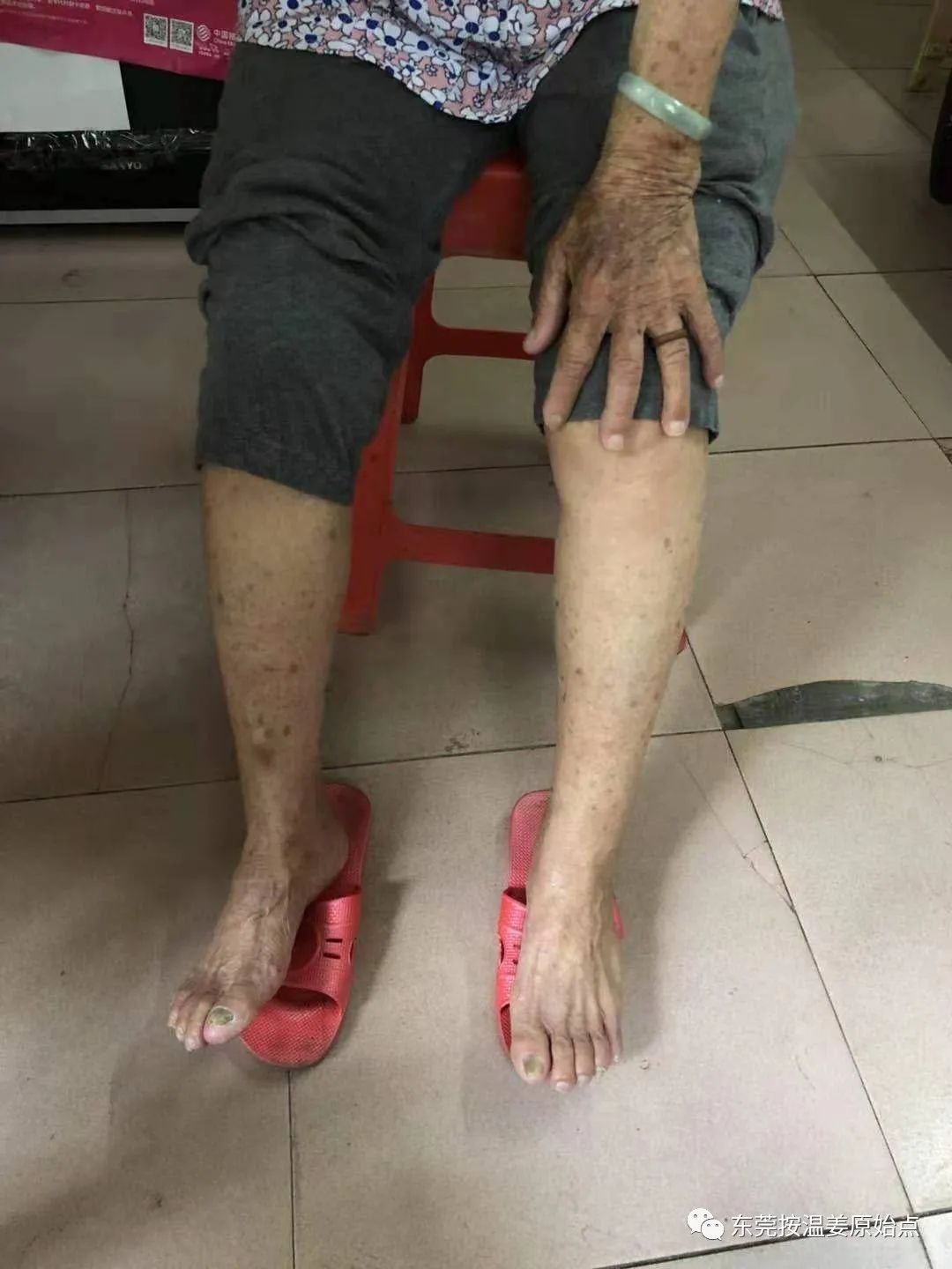 肝硬化肝腹水,双腿小肿,用原始点十天消肿 肝硬化肝腹水,双腿小肿,用原始点十天消肿