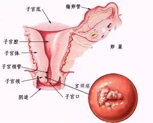 原始点调理晚期子宫癌康复案例+回访记录