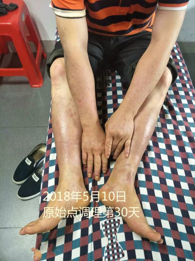 原始点调理十五年病史牛皮癣:30天大变样 原始点调理十五年病史牛皮癣:30天大变样