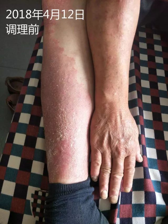 原始点调理十五年病史牛皮癣:30天大变样 原始点调理十五年病史牛皮癣:30天大变样