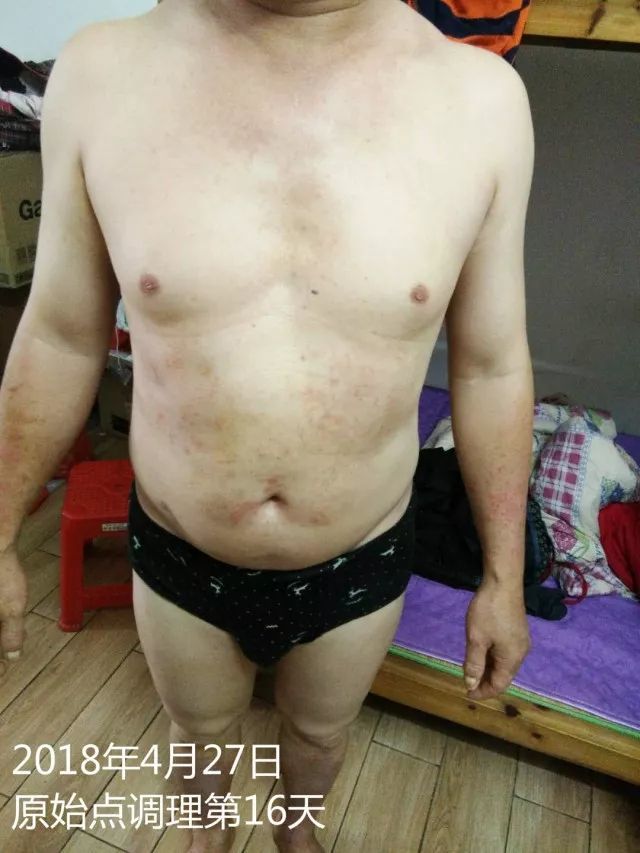 原始点调理十五年病史牛皮癣:30天大变样 原始点调理十五年病史牛皮癣:30天大变样