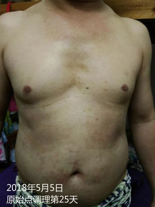 原始点调理十五年病史牛皮癣:30天大变样 原始点调理十五年病史牛皮癣:30天大变样