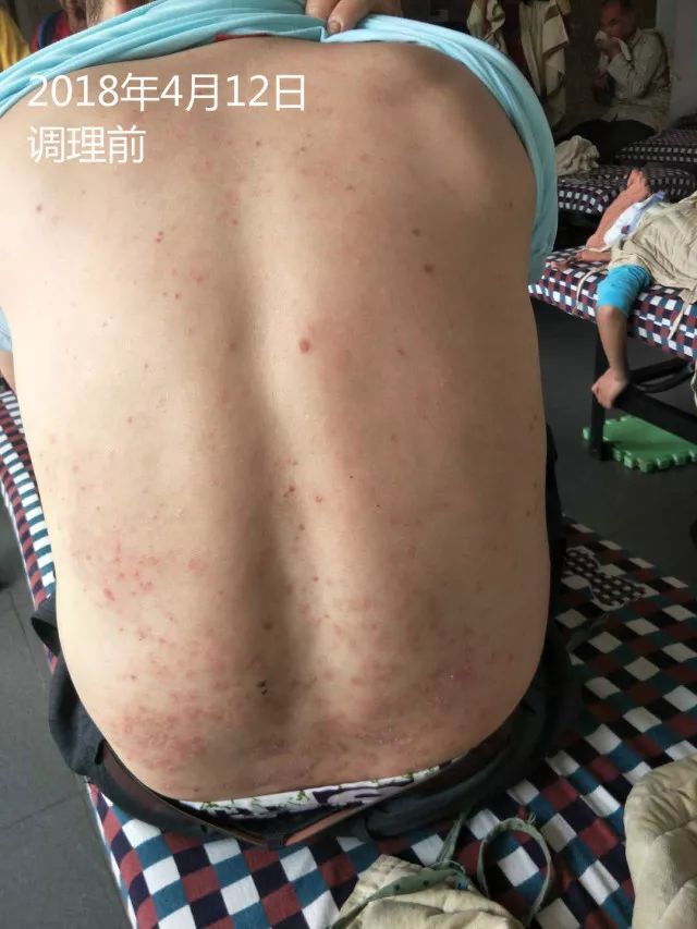 原始点调理十五年病史牛皮癣:30天大变样 原始点调理十五年病史牛皮癣:30天大变样