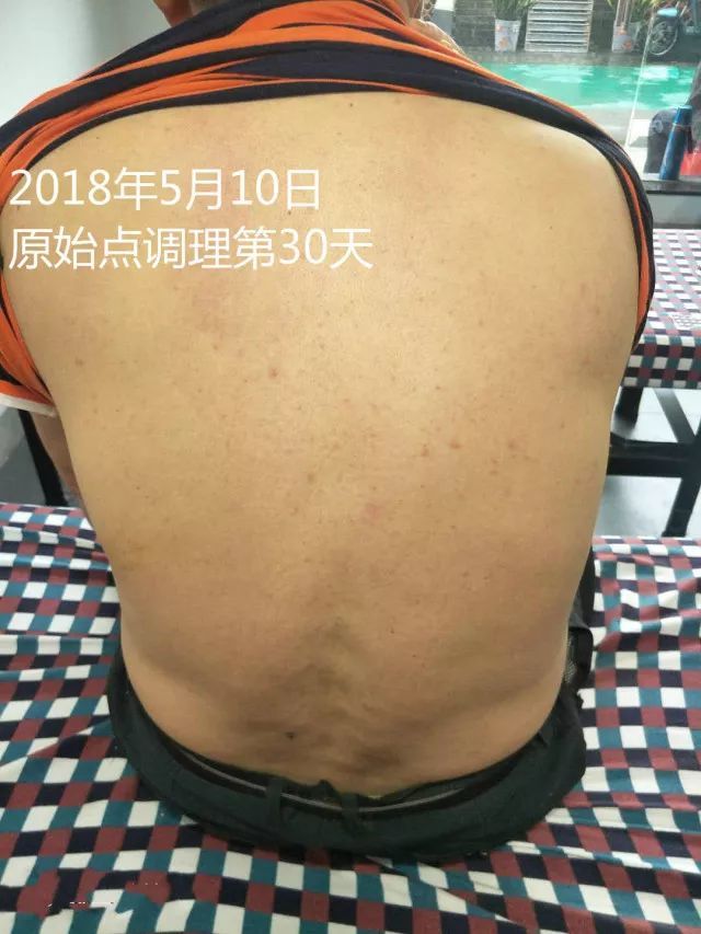 原始点调理十五年病史牛皮癣:30天大变样 原始点调理十五年病史牛皮癣:30天大变样