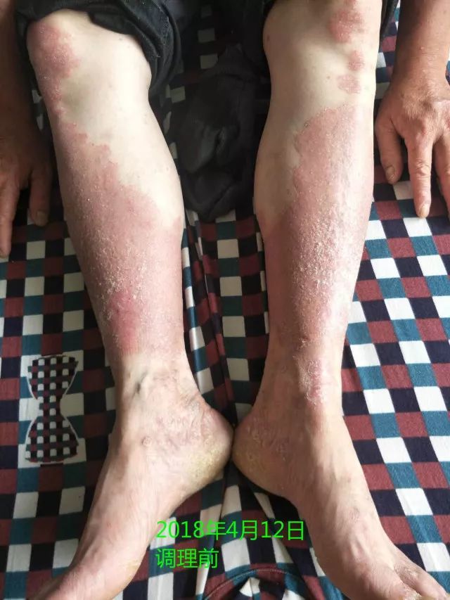 原始点调理十五年病史牛皮癣:30天大变样 原始点调理十五年病史牛皮癣:30天大变样