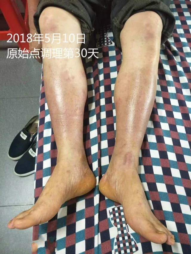 原始点调理十五年病史牛皮癣:30天大变样 原始点调理十五年病史牛皮癣:30天大变样