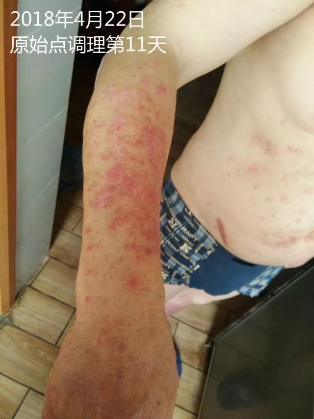 原始点调理十五年病史牛皮癣:30天大变样 原始点调理十五年病史牛皮癣:30天大变样