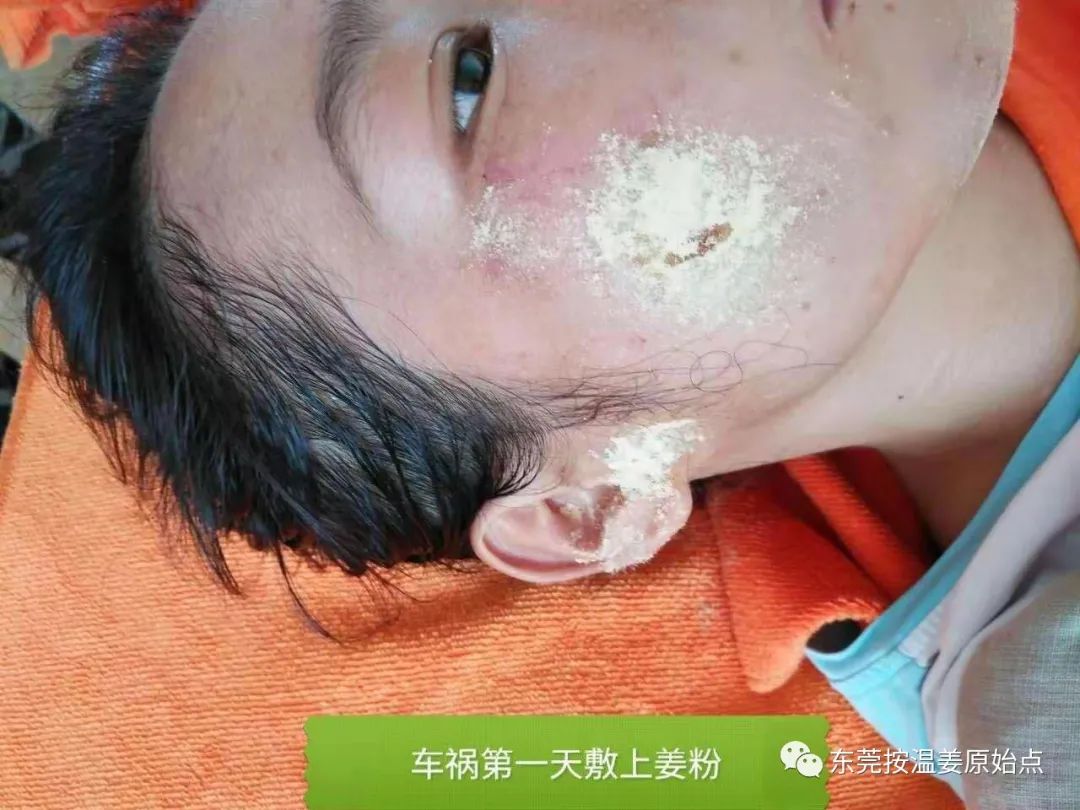 原始点处理肋骨断7根,胸腔积液等 原始点处理肋骨断7根,胸腔积液等