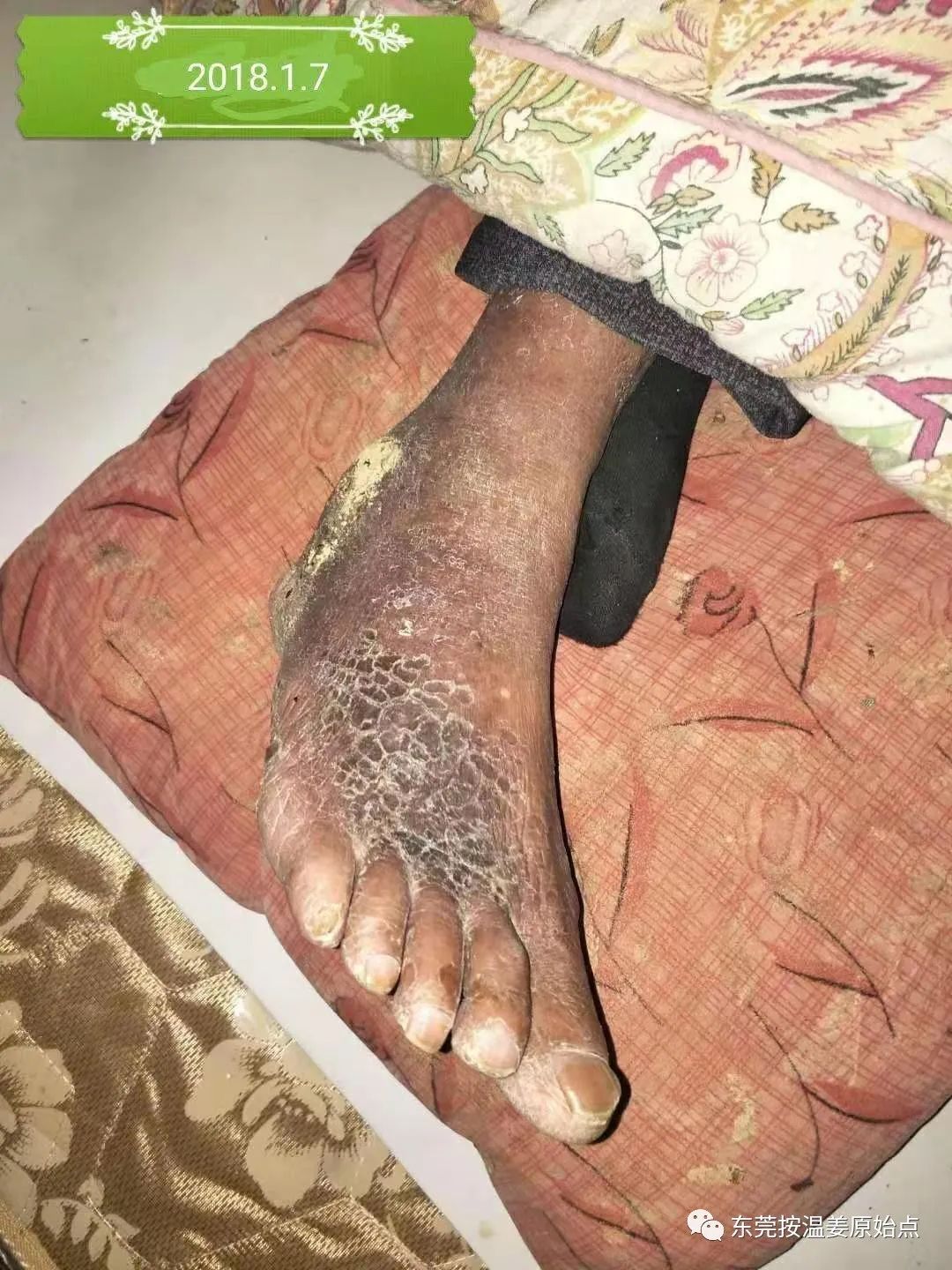 原始点让87岁中风的老爷爷免除截肢,重新行走 原始点让87岁中风的老爷爷免除截肢,重新行走