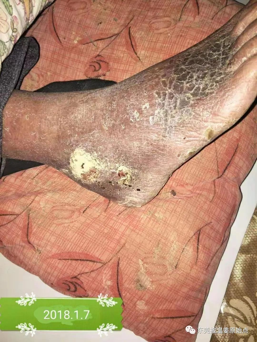 原始点让87岁中风的老爷爷免除截肢,重新行走 原始点让87岁中风的老爷爷免除截肢,重新行走