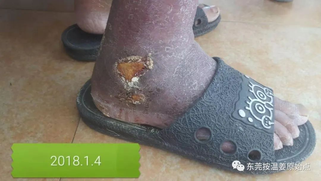 原始点让87岁中风的老爷爷免除截肢,重新行走 原始点让87岁中风的老爷爷免除截肢,重新行走