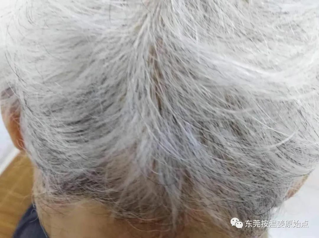 81岁老太太白发变黑 81岁老太太白发变黑