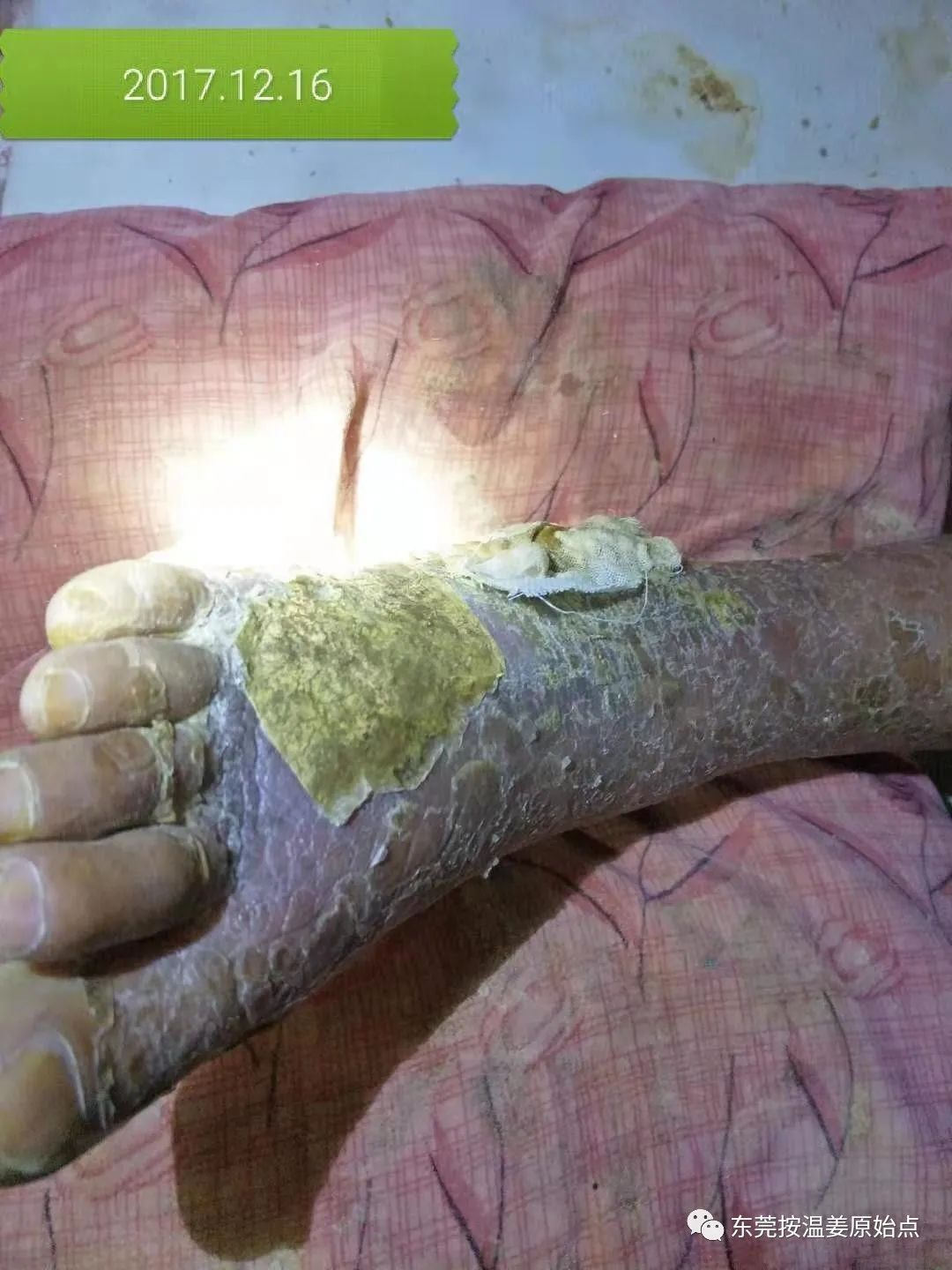 原始点让87岁中风的老爷爷免除截肢,重新行走 原始点让87岁中风的老爷爷免除截肢,重新行走