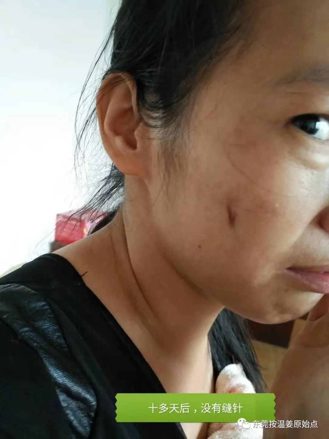 原始点处理肋骨断7根,胸腔积液等 原始点处理肋骨断7根,胸腔积液等