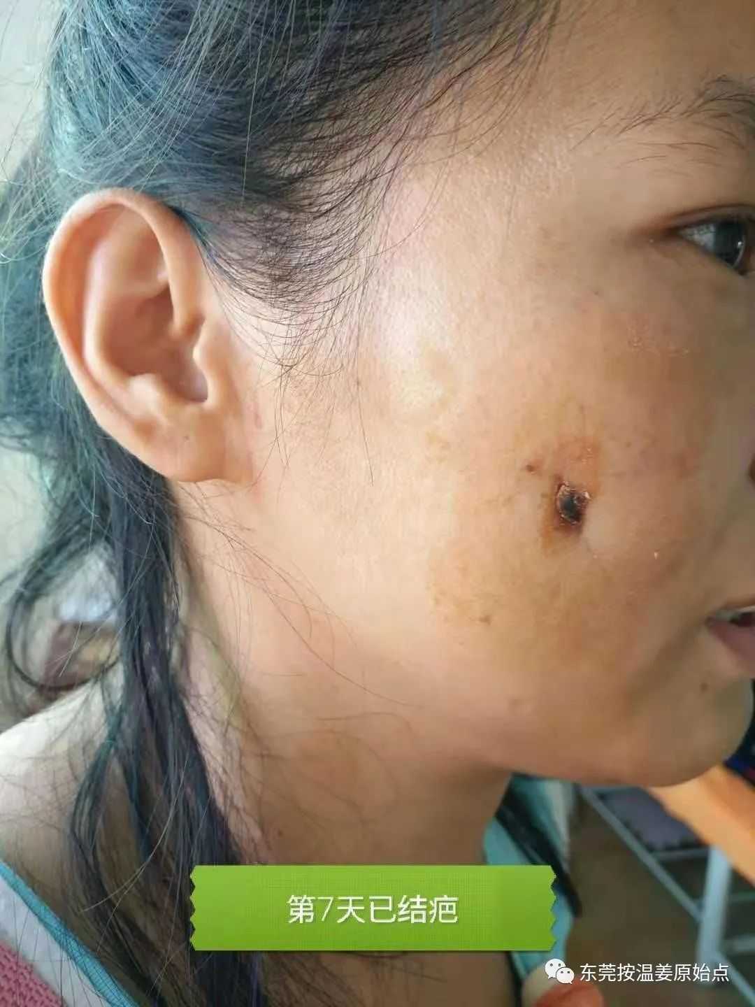 原始点处理肋骨断7根,胸腔积液等 原始点处理肋骨断7根,胸腔积液等