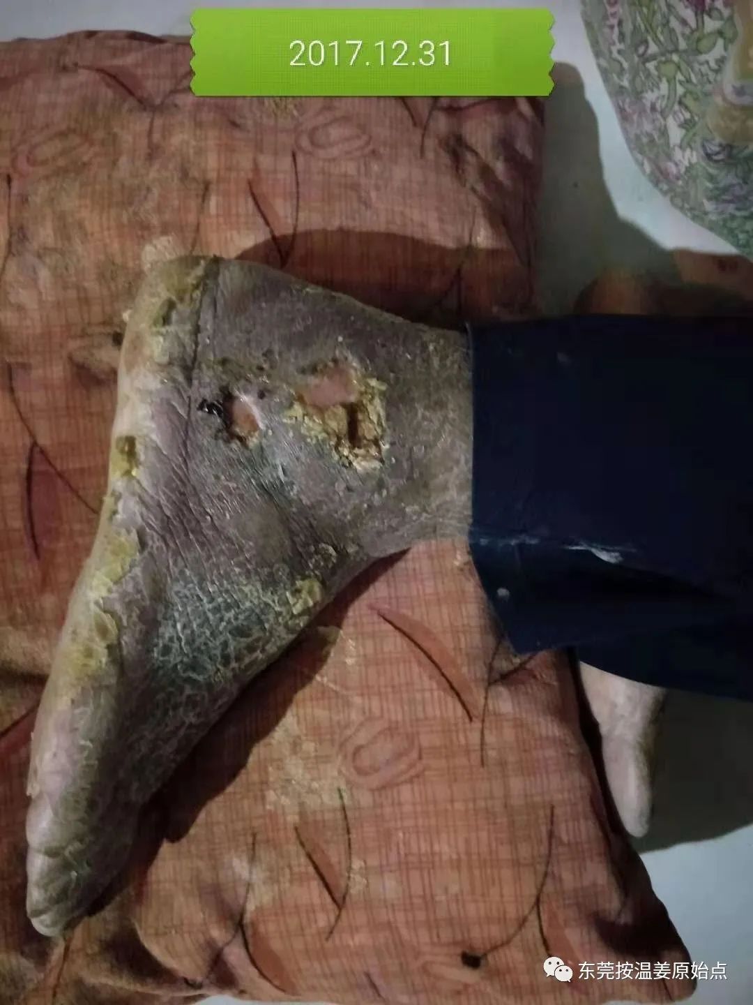 原始点让87岁中风的老爷爷免除截肢,重新行走 原始点让87岁中风的老爷爷免除截肢,重新行走