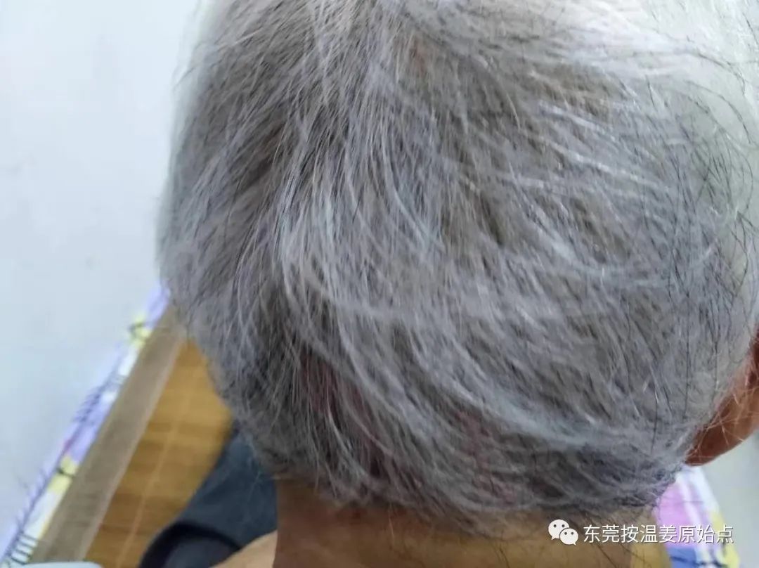 81岁老太太白发变黑 81岁老太太白发变黑