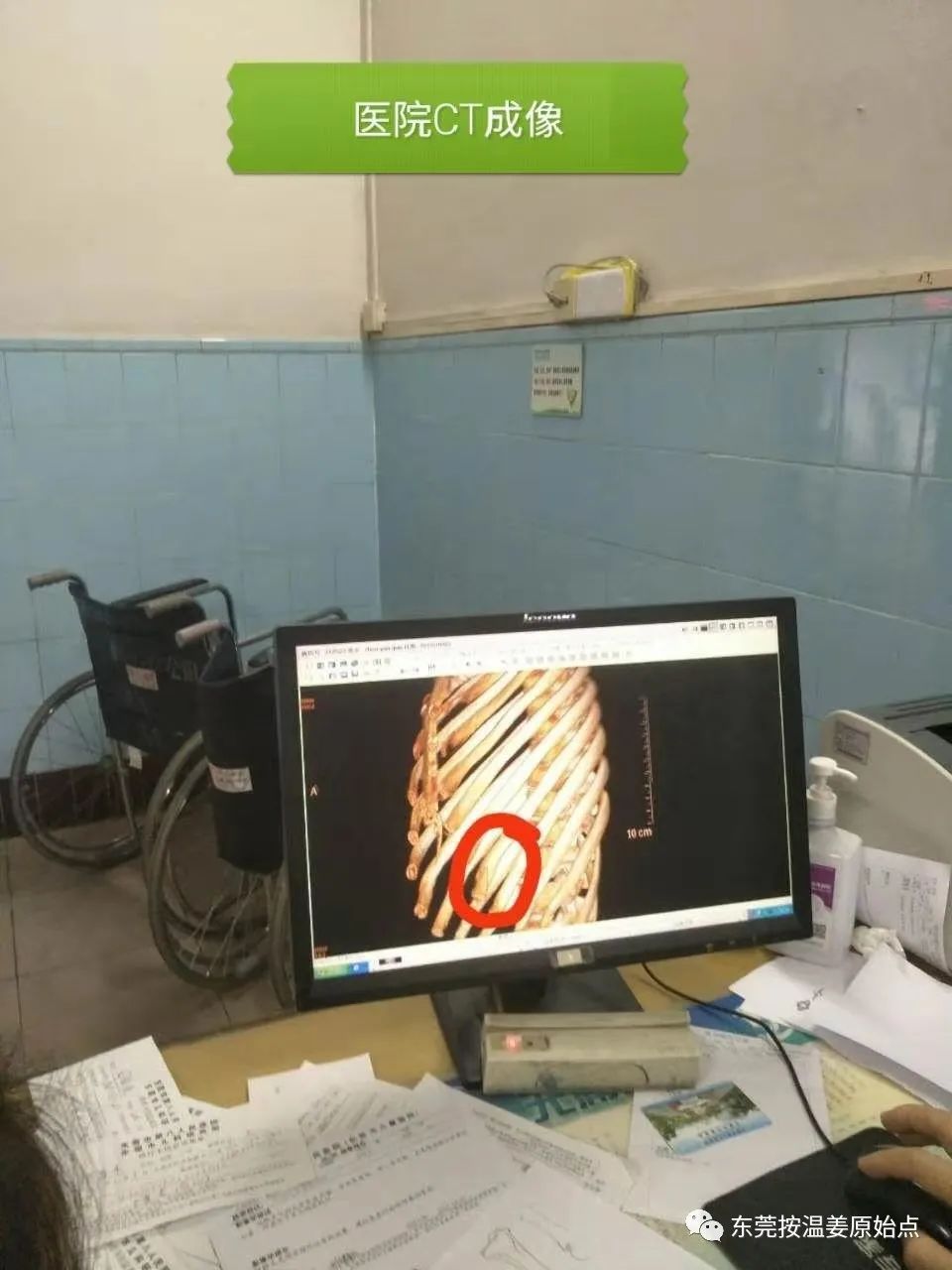 原始点处理肋骨断7根,胸腔积液等 原始点处理肋骨断7根,胸腔积液等