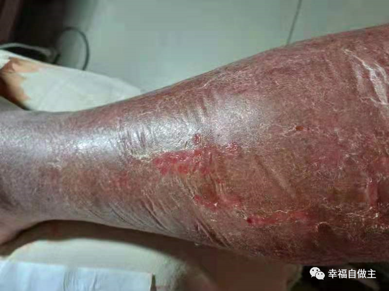 过敏性皮肤炎案例 过敏性皮肤炎案例