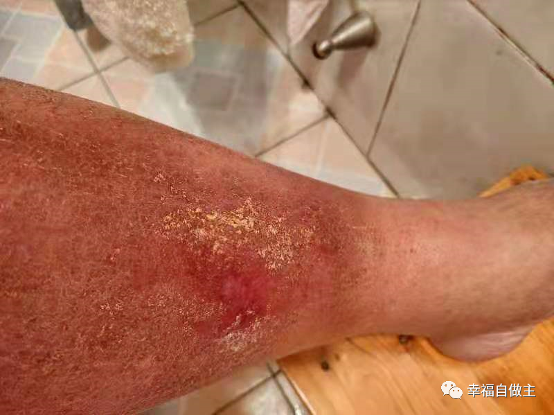 过敏性皮肤炎案例