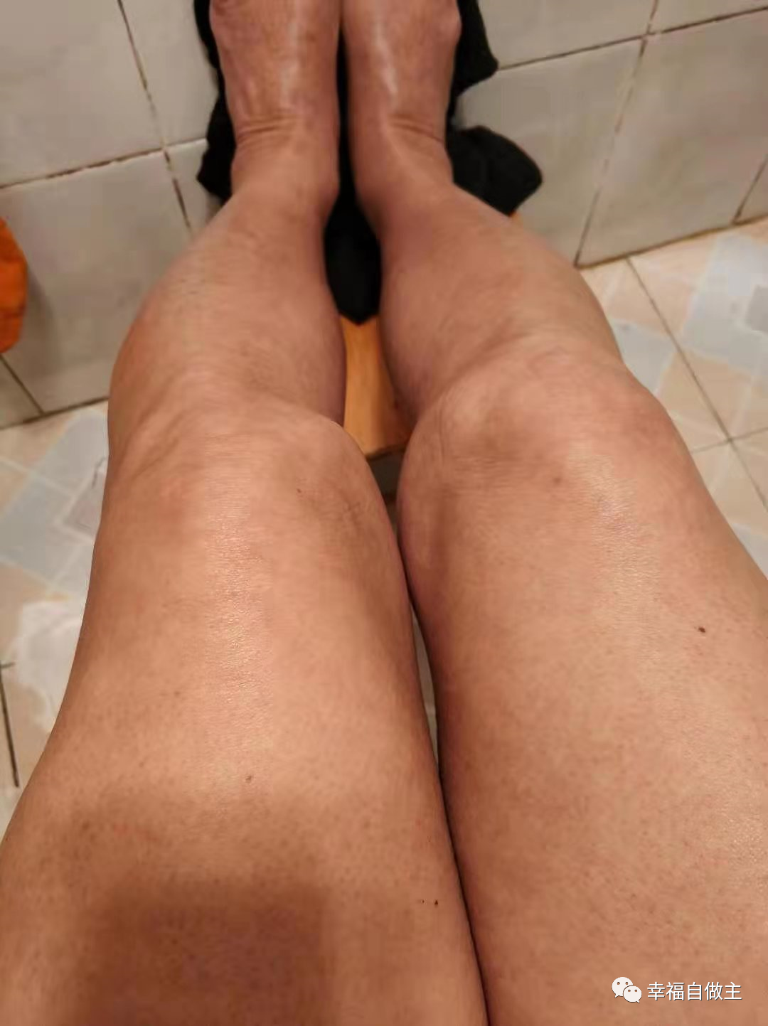 过敏性皮肤炎案例 过敏性皮肤炎案例