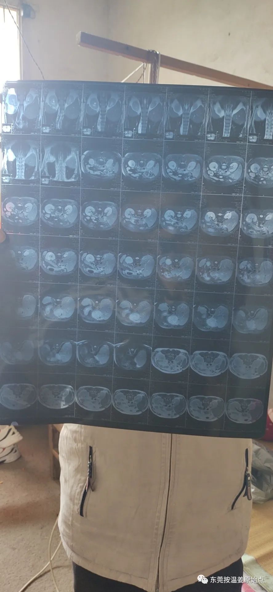 肝内胆结石,肝肿瘤80mm*70mm 肝内胆结石,肝肿瘤80mm*70mm