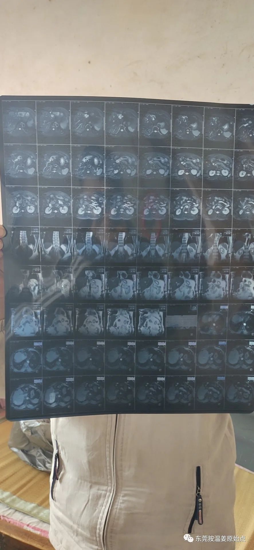 肝内胆结石,肝肿瘤80mm*70mm 肝内胆结石,肝肿瘤80mm*70mm