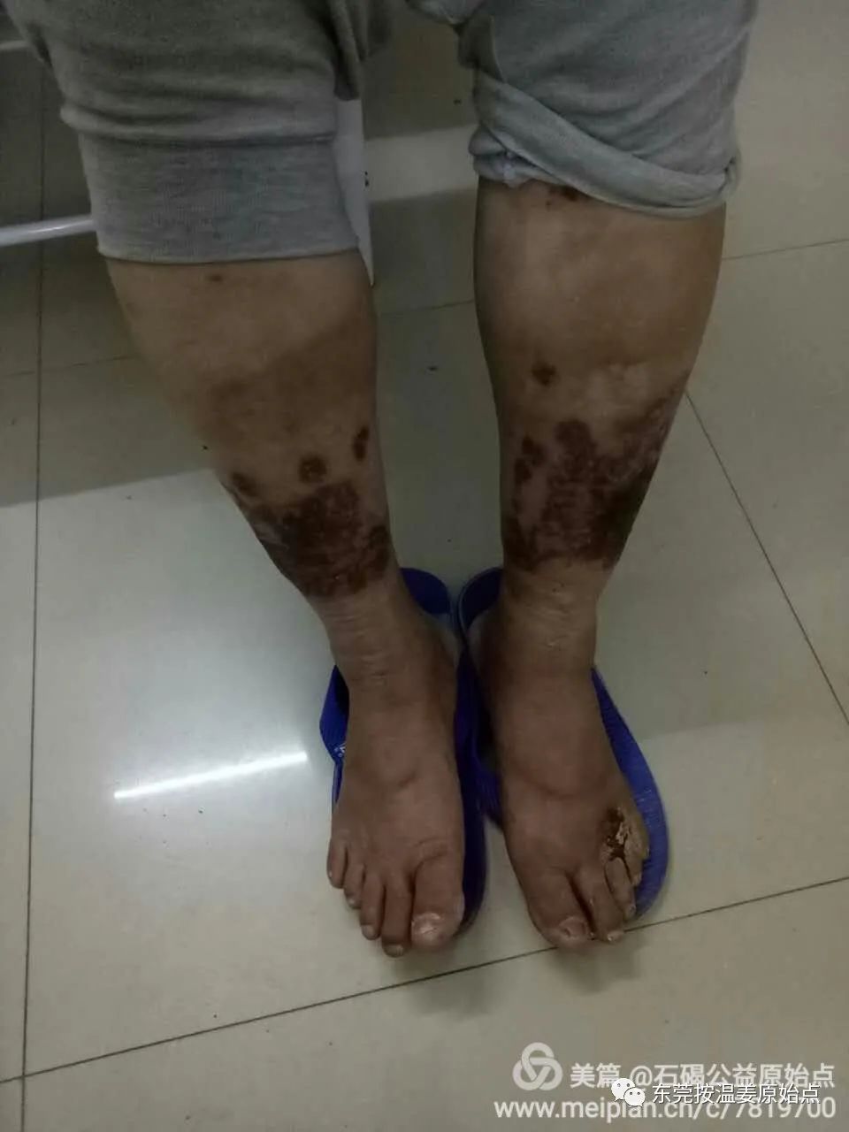 高血糖,双腿腐烂不愈合,西医认为需截肢 高血糖,双腿腐烂不愈合,西医认为需截肢