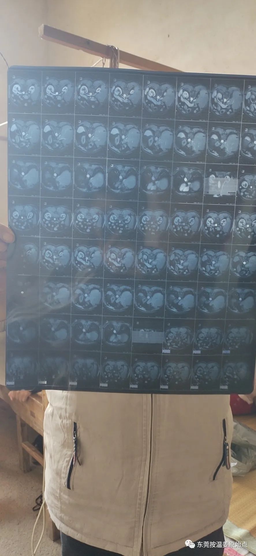 肝内胆结石,肝肿瘤80mm*70mm 肝内胆结石,肝肿瘤80mm*70mm