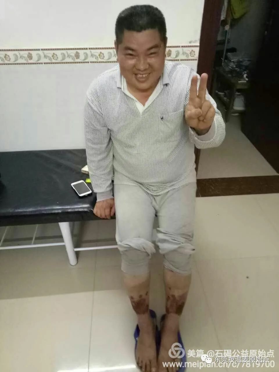 高血糖,双腿腐烂不愈合,西医认为需截肢 高血糖,双腿腐烂不愈合,西医认为需截肢