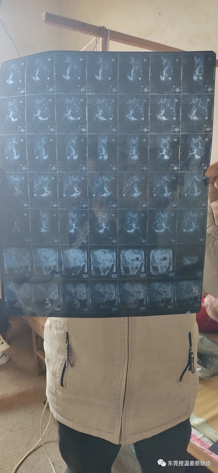 肝内胆结石,肝肿瘤80mm*70mm 肝内胆结石,肝肿瘤80mm*70mm