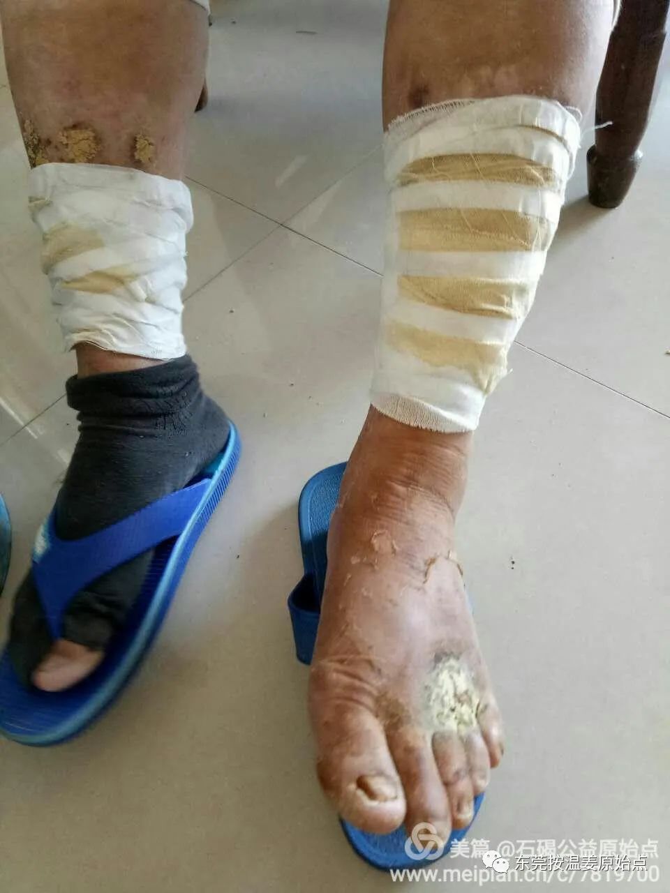 高血糖,双腿腐烂不愈合,西医认为需截肢 高血糖,双腿腐烂不愈合,西医认为需截肢
