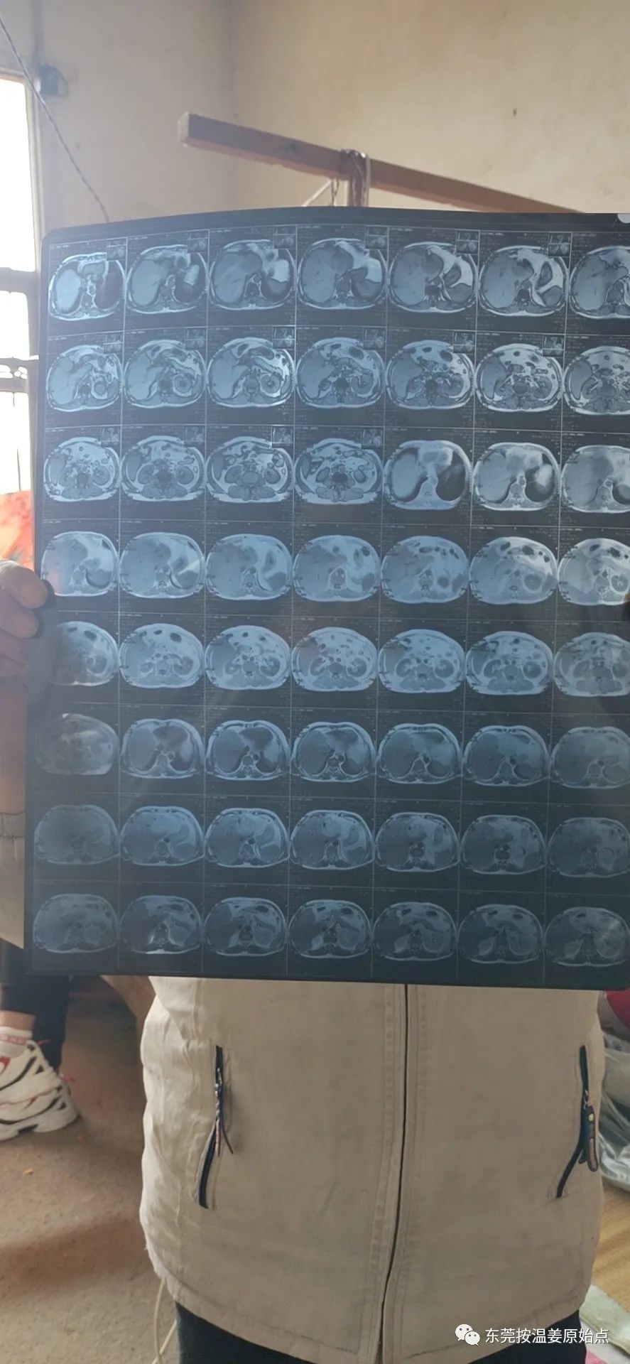 肝内胆结石,肝肿瘤80mm*70mm 肝内胆结石,肝肿瘤80mm*70mm