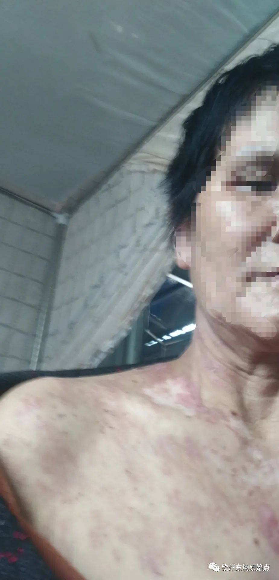 带状疱疹案例 带状疱疹案例