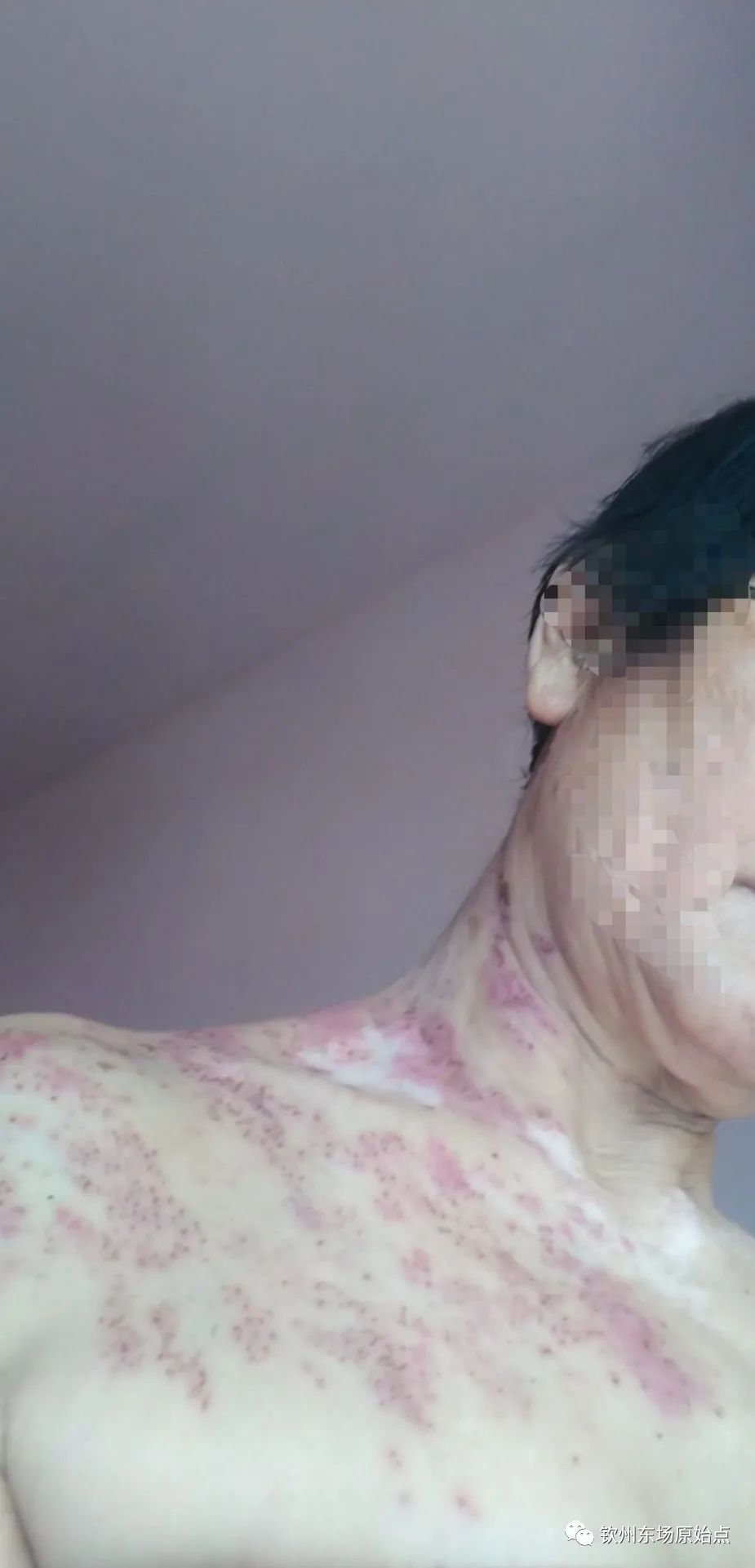 带状疱疹案例 带状疱疹案例