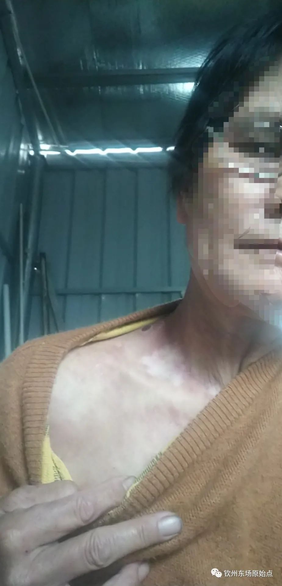 带状疱疹案例 带状疱疹案例