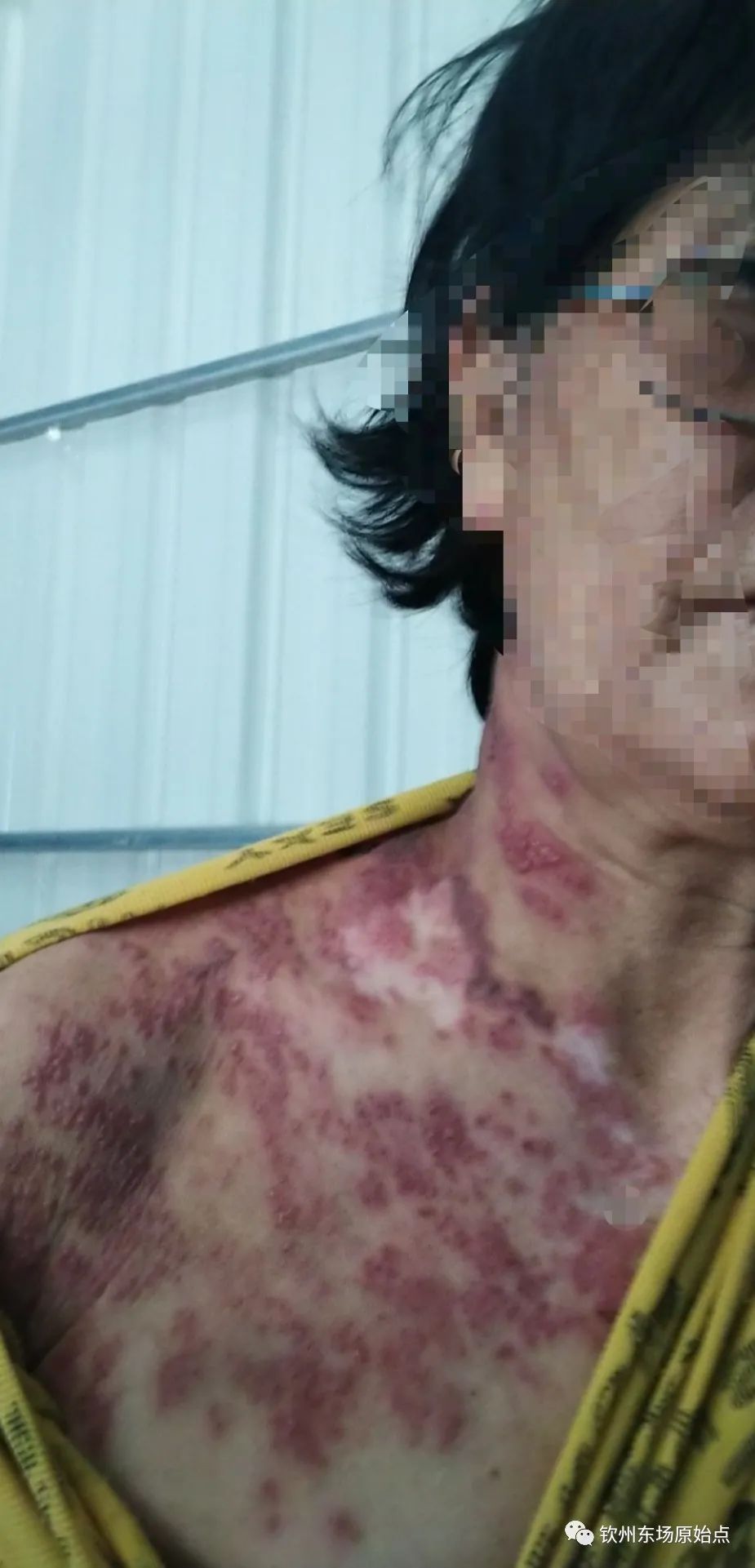 带状疱疹案例 带状疱疹案例