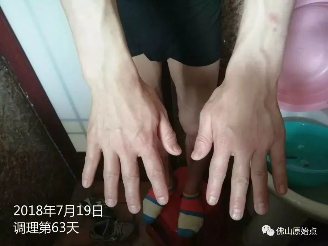 原始点调理严重牛皮癣及静脉曲张:84天完好如初 原始点调理严重牛皮癣及静脉曲张:84天完好如初