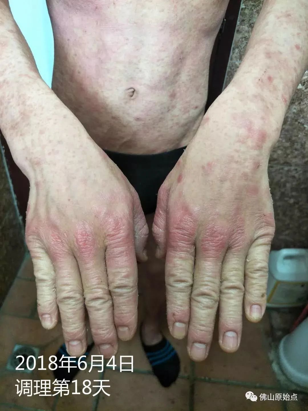 原始点调理严重牛皮癣及静脉曲张:84天完好如初 原始点调理严重牛皮癣及静脉曲张:84天完好如初